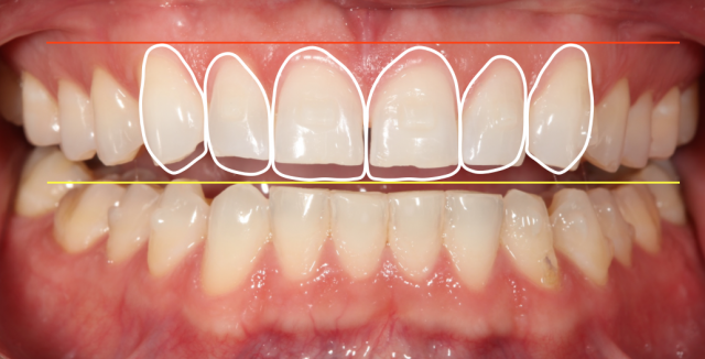 Diagnostic Wax-Up Fabrication: Pre-Restorative Treatment and Ortho RobertWinter diagnostic wax up fabrication pre restorative treatment and ortho Fig.2