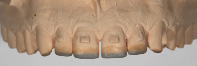 Diagnostic Wax-Up Fabrication: Pre-Restorative Treatment and Ortho RobertWinter diagnostic wax up fabrication pre restorative treatment and ortho Fig.3
