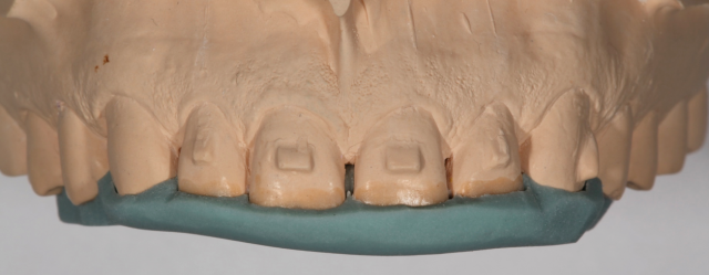 Diagnostic Wax-Up Fabrication: Pre-Restorative Treatment and Ortho RobertWinter diagnostic wax up fabrication pre restorative treatment and ortho Fig.4