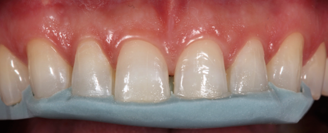 Diagnostic Wax-Up Fabrication: Pre-Restorative Treatment and Ortho RobertWinter diagnostic wax up fabrication pre restorative treatment and ortho Fig.5