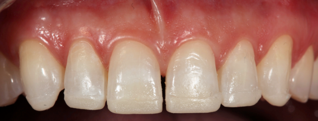 Diagnostic Wax-Up Fabrication: Pre-Restorative Treatment and Ortho RobertWinter diagnostic wax up fabrication pre restorative treatment and ortho Fig.6