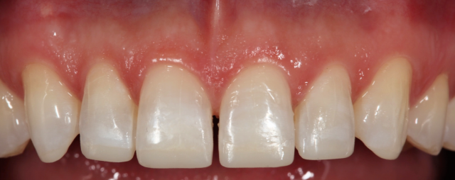 Diagnostic Wax-Up Fabrication: Pre-Restorative Treatment and Ortho RobertWinter diagnostic wax up fabrication pre restorative treatment and ortho Fig.7