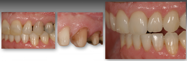 How To Restore Severely Discolored Teeth RobertWinter how to restore severely discolored teeth Fig.1