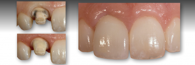 How To Restore Severely Discolored Teeth RobertWinter how to restore severely discolored teeth Fig.2