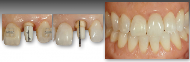 How To Restore Severely Discolored Teeth RobertWinter how to restore severely discolored teeth Fig.3