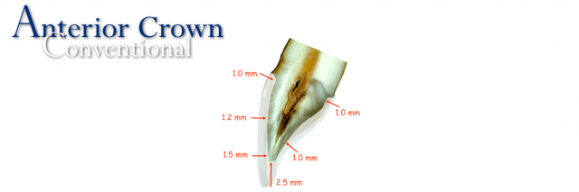 How To Restore Severely Discolored Teeth RobertWinter how to restore severely discolored teeth Fig.4