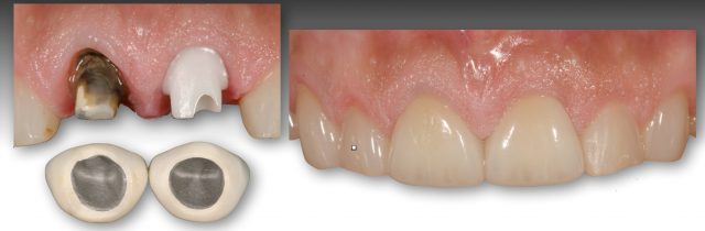 How To Restore Severely Discolored Teeth RobertWinter how to restore severely discolored teeth Fig.5