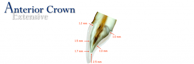 How To Restore Severely Discolored Teeth RobertWinter how to restore severely discolored teeth Fig.6