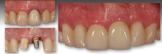 How To Restore Severely Discolored Teeth RobertWinter how to restore severely discolored teeth Fig.7