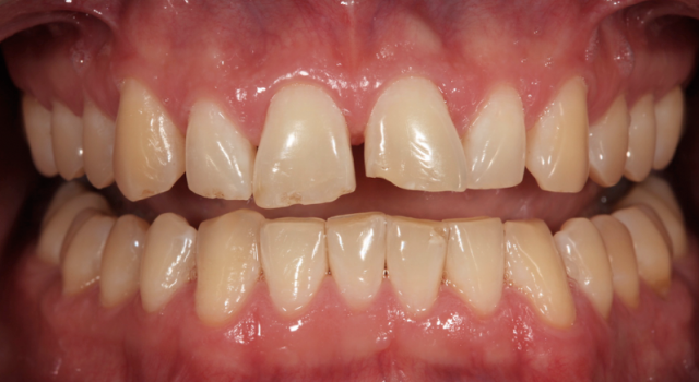Why You Should Do a Diagnostic Wax-Up RobertWinter why you should do a diagnostic wax up Fig.1