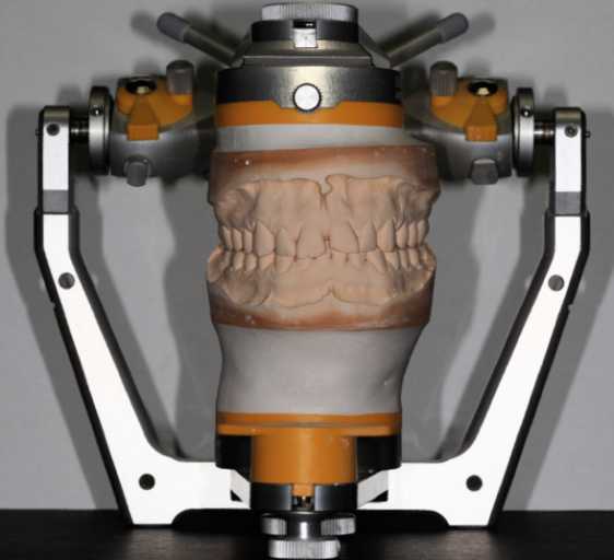 Why You Should Do a Diagnostic Wax-Up RobertWinter why you should do a diagnostic wax up Fig.3