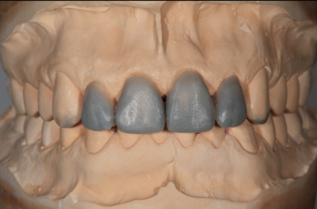 Why You Should Do a Diagnostic Wax-Up RobertWinter why you should do a diagnostic wax up Fig.4