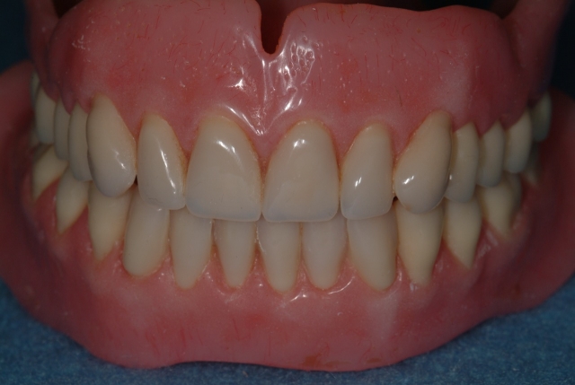 Should Dentists Recommend Wearing Dentures During Sleep? Rouse should dentists recommend dentures 01
