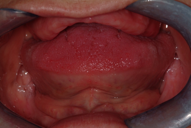 Should Dentists Recommend Wearing Dentures During Sleep? Rouse should dentists recommend dentures 02