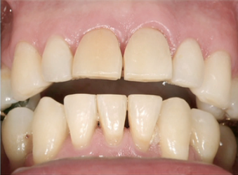 Spear Treating Excess Overjet Featured Image