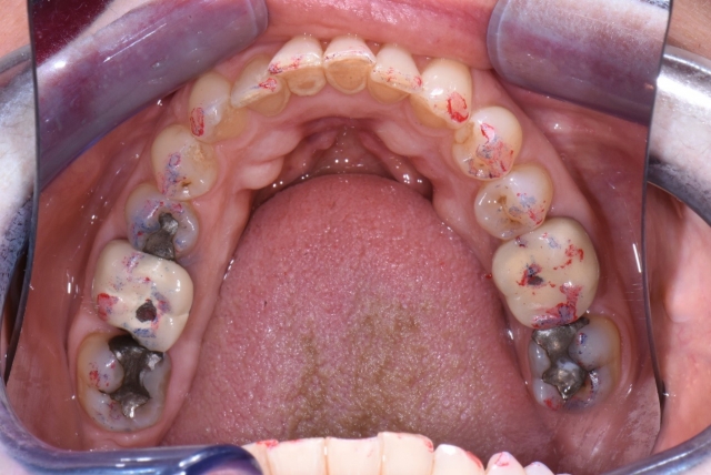 What Happens When You Have To Extract and Replace a Molar? Steinberg what happens when you extract molar 01