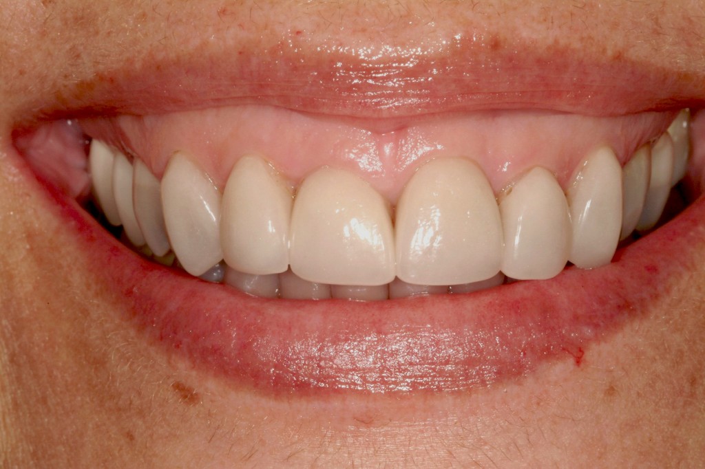 Steve Ratcliff What To Do With a Gummy Smile Featured Image