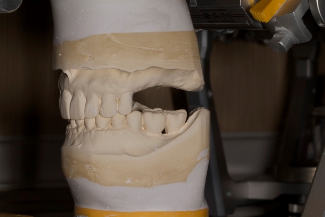 Creating a Radiographic Template for Implant Planning Step-by-Step Steve Ratcliffe Creating a Radiographic Template for Implant Planning Step by Step Figure 1