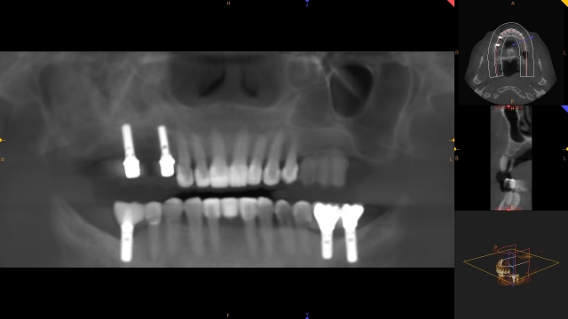 Creating a Radiographic Template for Implant Planning Step-by-Step Steve Ratcliffe Creating a Radiographic Template for Implant Planning Step by Step Figure 10