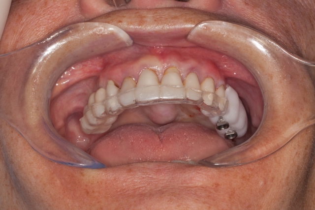 Creating a Radiographic Template for Implant Planning Step-by-Step Steve Ratcliffe Creating a Radiographic Template for Implant Planning Step by Step Figure 11