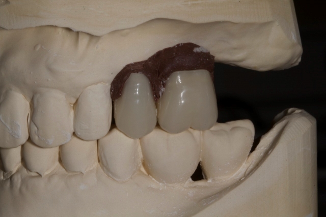 Creating a Radiographic Template for Implant Planning Step-by-Step Steve Ratcliffe Creating a Radiographic Template for Implant Planning Step by Step Figure 2