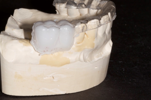 Creating a Radiographic Template for Implant Planning Step-by-Step Steve Ratcliffe Creating a Radiographic Template for Implant Planning Step by Step Figure 6