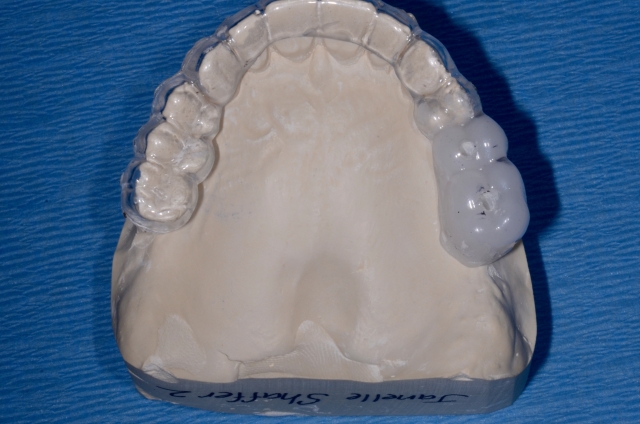 Creating a Radiographic Template for Implant Planning Step-by-Step Steve Ratcliffe Creating a Radiographic Template for Implant Planning Step by Step Figure 7