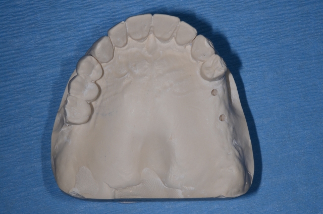 Creating a Radiographic Template for Implant Planning Step-by-Step Steve Ratcliffe Creating a Radiographic Template for Implant Planning Step by Step Figure 8