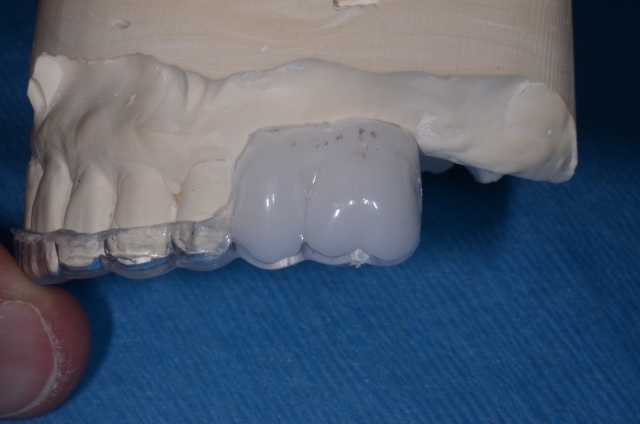 Creating a Radiographic Template for Implant Planning Step-by-Step Steve Ratcliffe Creating a Radiographic Template for Implant Planning Step by Step Figure 9