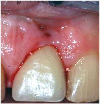 Implant Maintenance for Long-Term Success Steve Ratcliffe Implant Maintenance for Long Term Success Figure 1