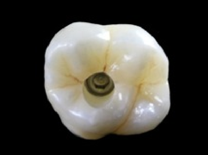 Implant Maintenance for Long-Term Success Steve Ratcliffe Implant Maintenance for Long Term Success Figure 4