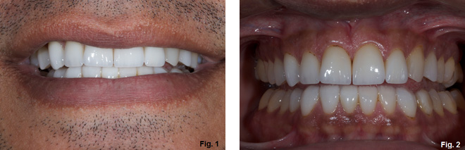 Where's the Overjet: Why Veneers Are Breaking Off Steve Ratcliffe Wheres the Overjet Why Veneers Are Breaking Off Figure 1 2