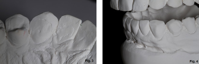 Where's the Overjet: Why Veneers Are Breaking Off Steve Ratcliffe Wheres the Overjet Why Veneers Are Breaking Off Figure 3 4