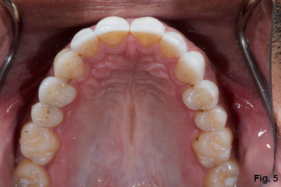 Where's the Overjet: Why Veneers Are Breaking Off Steve Ratcliffe Wheres the Overjet Why Veneers Are Breaking Off Figure 5