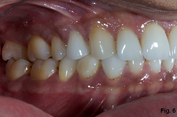 Where's the Overjet: Why Veneers Are Breaking Off Steve Ratcliffe Wheres the Overjet Why Veneers Are Breaking Off Figure 6