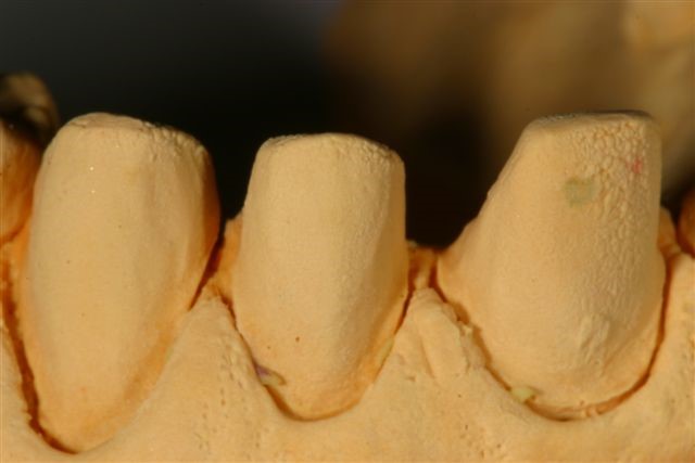 SteveRatcliff dental impression problems why you get them and how to avoid them Fig.1
