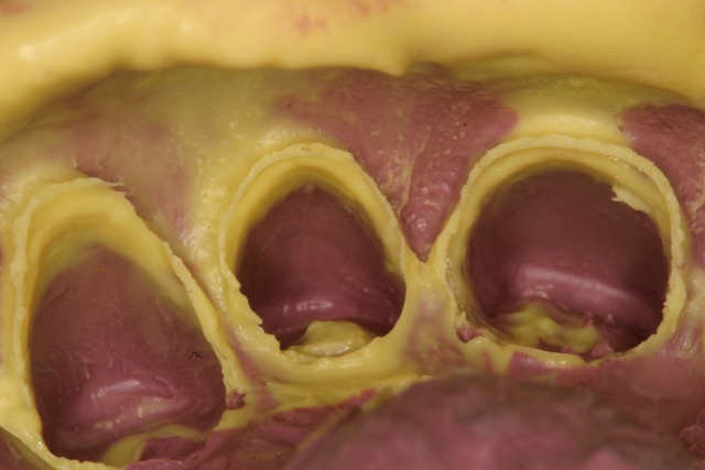 SteveRatcliff dental impression problems why you get them and how to avoid them Fig.2