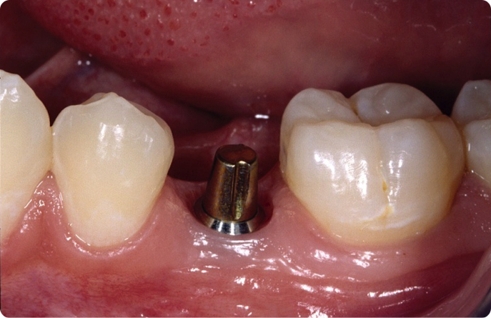 Implant Abutments: What Do I Choose? SteveRatcliff implant abutments choose FeaturedImage