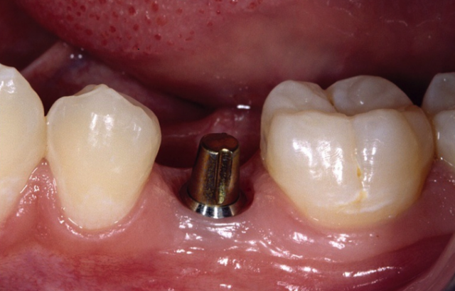Implant Abutments: What Do I Choose? SteveRatcliff implant abutments choose Fig.1