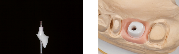 Implant Abutments: What Do I Choose? SteveRatcliff implant abutments choose Fig.3