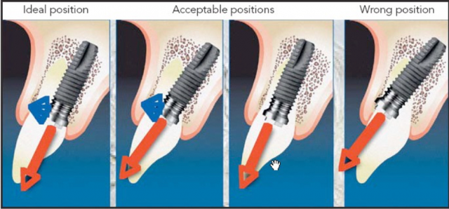 Screw-Retained Restorations With Off-Angle Implants SteveRatcliff screw retained restorations with off angle implants Fig.1