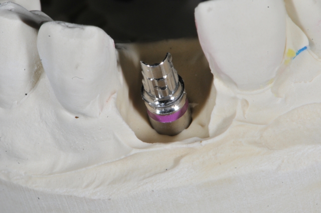 Screw-Retained Restorations With Off-Angle Implants SteveRatcliff screw retained restorations with off angle implants Fig.10