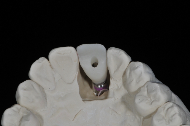 Screw-Retained Restorations With Off-Angle Implants SteveRatcliff screw retained restorations with off angle implants Fig.11