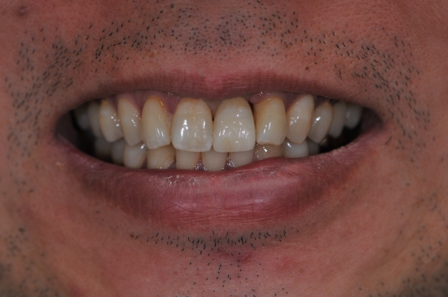 Screw-Retained Restorations With Off-Angle Implants SteveRatcliff screw retained restorations with off angle implants Fig.112