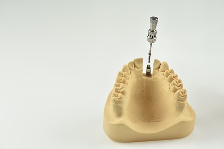 Screw-Retained Restorations With Off-Angle Implants SteveRatcliff screw retained restorations with off angle implants Fig.6