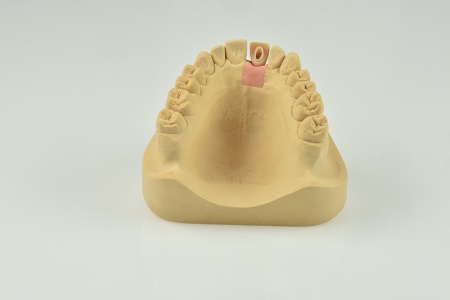 Screw-Retained Restorations With Off-Angle Implants SteveRatcliff screw retained restorations with off angle implants Fig.8