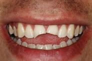 Can Bonding Broken Tooth Fragments Really Work?
