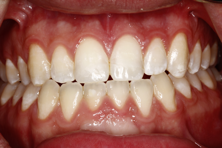 Can Bonding Broken Tooth Fragments Really Work? Vivek Mehta Bonding Broken Tooth Fragments Fig2