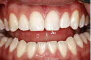 Can Bonding Broken Tooth Fragments Really Work? Vivek Mehta Bonding Broken Tooth Fragments Fig3