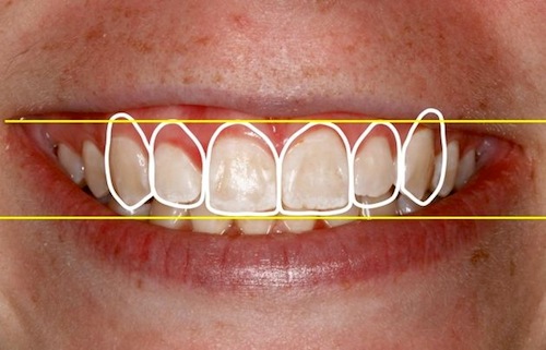 Five Critical Criteria for Digital Smile Design Vivek Mehta Five Critical Criteria for Digital Smile Design Featured Image
